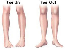 in-toe-walking